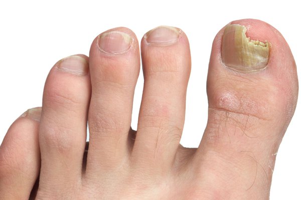 fungal toenail
